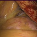 laparoskopischer Blick auf ein gesundes Pankreas