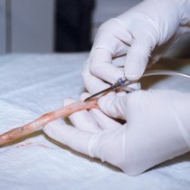 Entnahme von Blut aus dem Nabelschnurrest