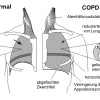 Störung der Lungenfunktion durch COPD