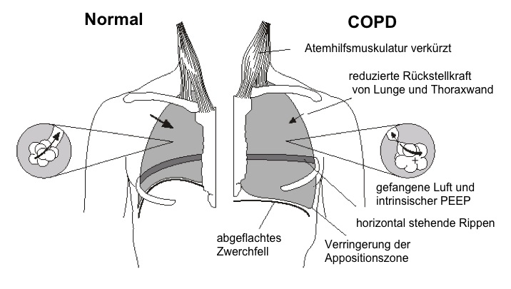 Störung der Lungenfunktion durch COPD